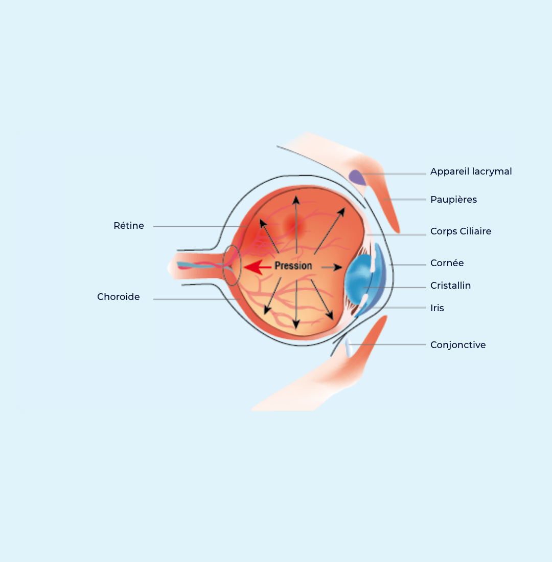 glaucoma glaucoma